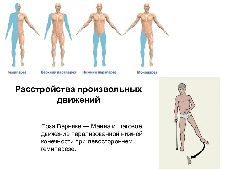 Поза Вернике — Манна и шаговое движение парализованной нижней конечности при левостороннем гемипарезе. Расстройства произвольных движений