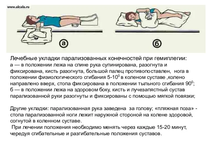 Лечебные укладки парализованных конечностей при гемиплегии: а — в положении лежа на спине