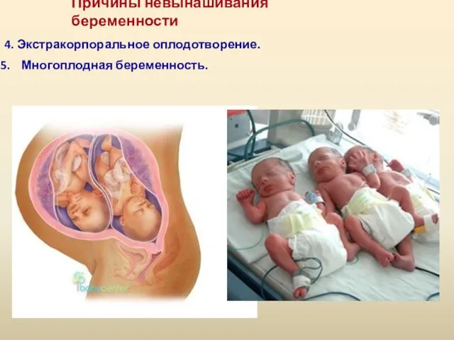 4. Экстракорпоральное оплодотворение. Многоплодная беременность. Причины невынашивания беременности