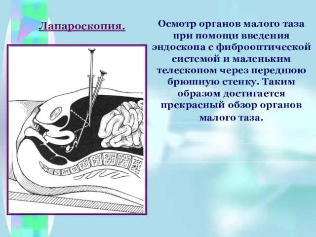 Осмотр органов малого таза при помощи введения эндоскопа с фиброоптической