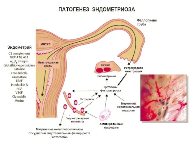 ПАТОГЕНЕЗ ЭНДОМЕТРИОЗА