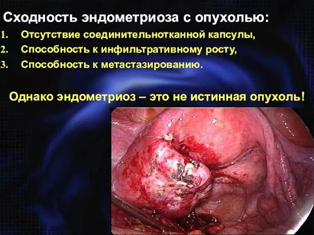 Сходность эндометриоза с опухолью: Отсутствие соединительнотканной капсулы, Способность к инфильтративному