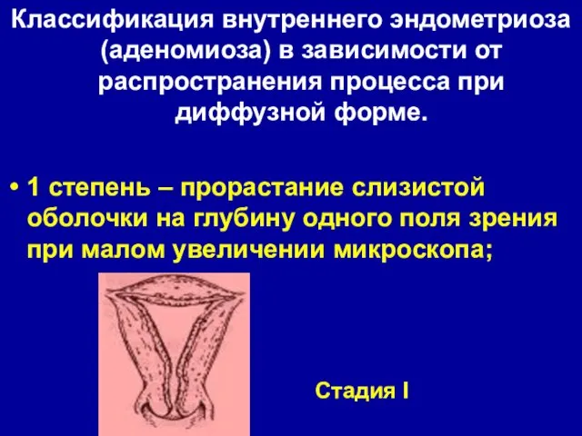 Классификация внутреннего эндометриоза (аденомиоза) в зависимости от распространения процесса при