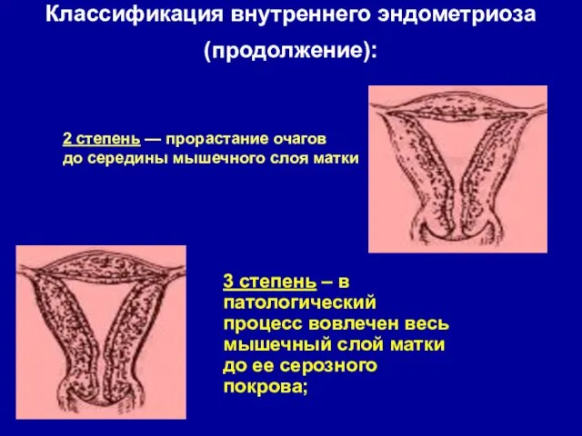 Классификация внутреннего эндометриоза (продолжение): 3 степень – в патологический процесс