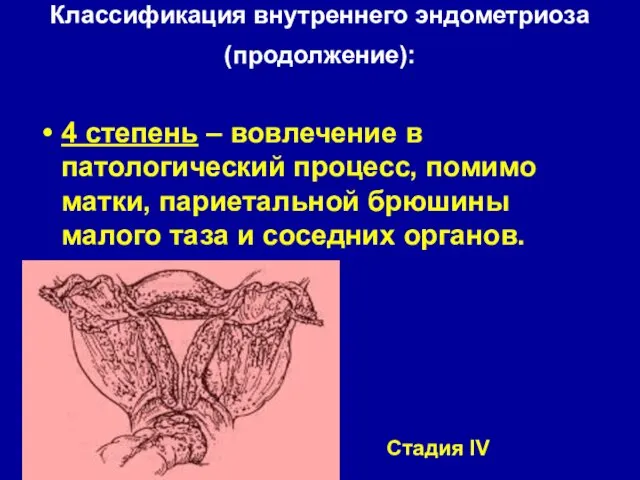 Классификация внутреннего эндометриоза (продолжение): 4 степень – вовлечение в патологический