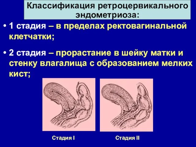 1 стадия – в пределах ректовагинальной клетчатки; 2 стадия –