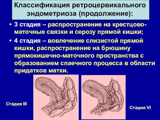 Классификация ретроцервикального эндометриоза (продолжение): 3 стадия – распространение на крестцово-маточные