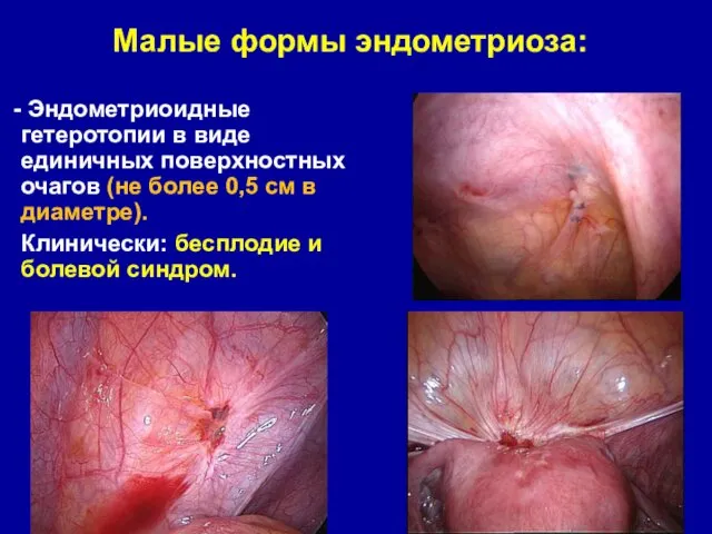 Малые формы эндометриоза: Эндометриоидные гетеротопии в виде единичных поверхностных очагов
