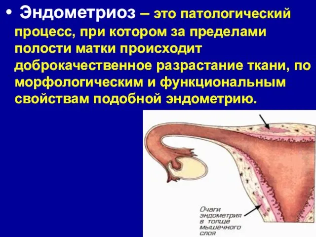 Эндометриоз – это патологический процесс, при котором за пределами полости