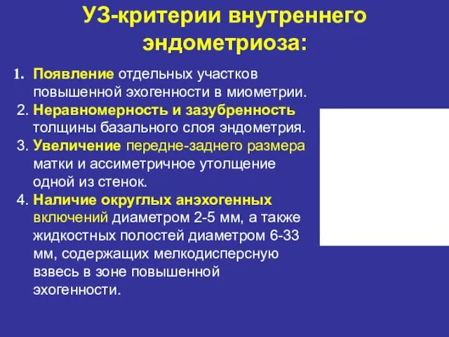 УЗ-критерии внутреннего эндометриоза: Появление отдельных участков повышенной эхогенности в миометрии.