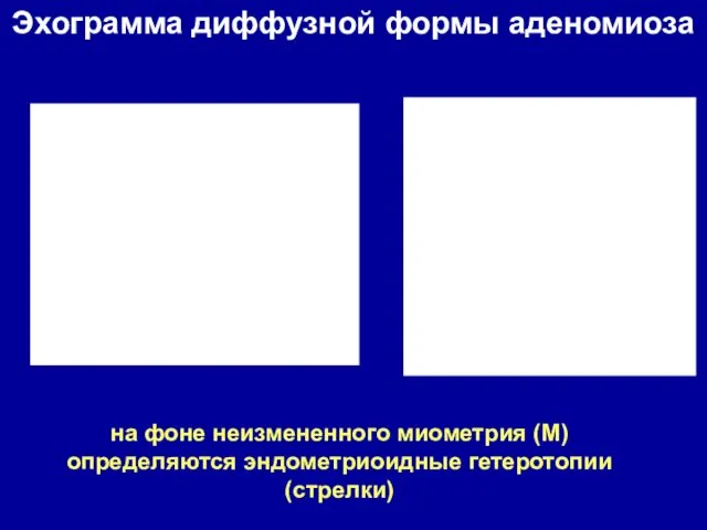 на фоне неизмененного миометрия (М) определяются эндометриоидные гетеротопии (стрелки) Эхограмма диффузной формы аденомиоза