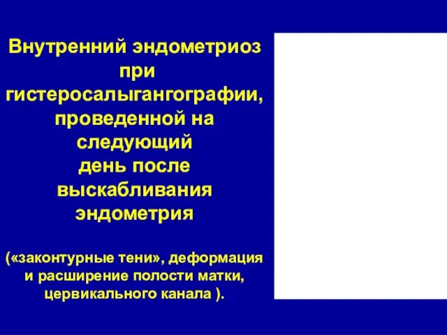 Внутренний эндометриоз при гистеросалыгангографии, проведенной на следующий день после выскабливания