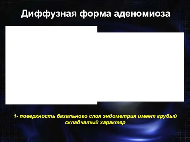 Диффузная форма аденомиоза 1- поверхность базального слоя эндометрия имеет грубый складчатый характер 1