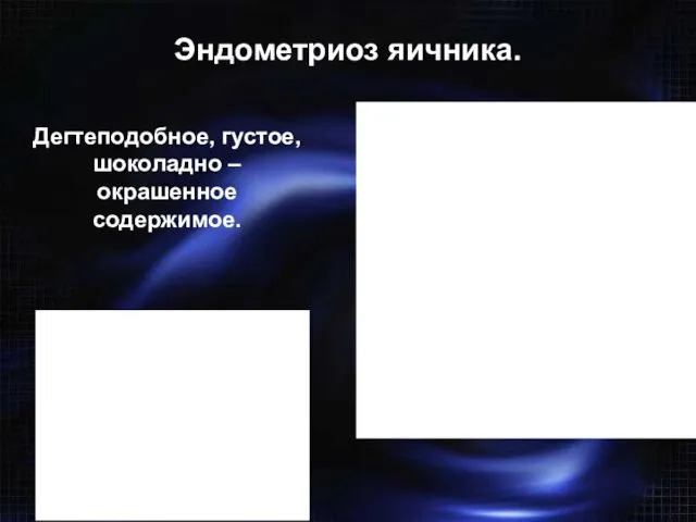 Эндометриоз яичника. Дегтеподобное, густое, шоколадно – окрашенное содержимое. Точность диагностики эндометриом при лапароскопии – 98-100%