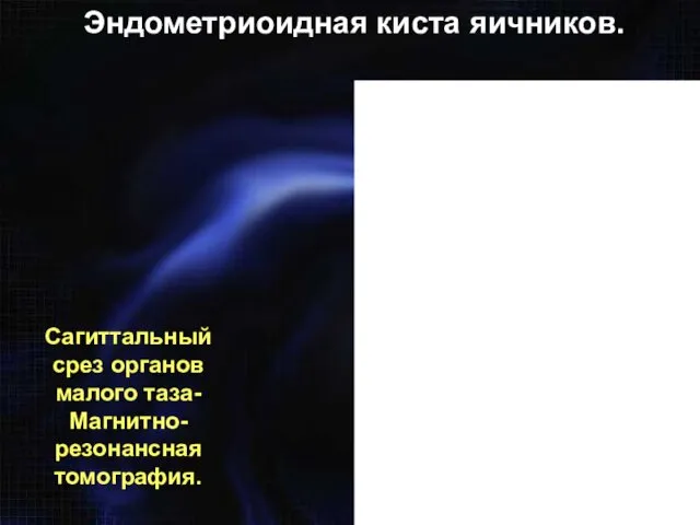 Сагиттальный срез органов малого таза- Магнитно-резонансная томография. Эндометриоидная киста яичников.