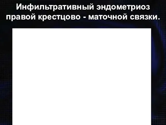 Инфильтративный эндометриоз правой крестцово - маточной связки.