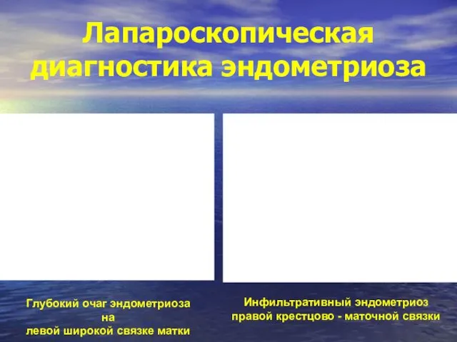 Лапароскопическая диагностика эндометриоза Инфильтративный эндометриоз правой крестцово - маточной связки