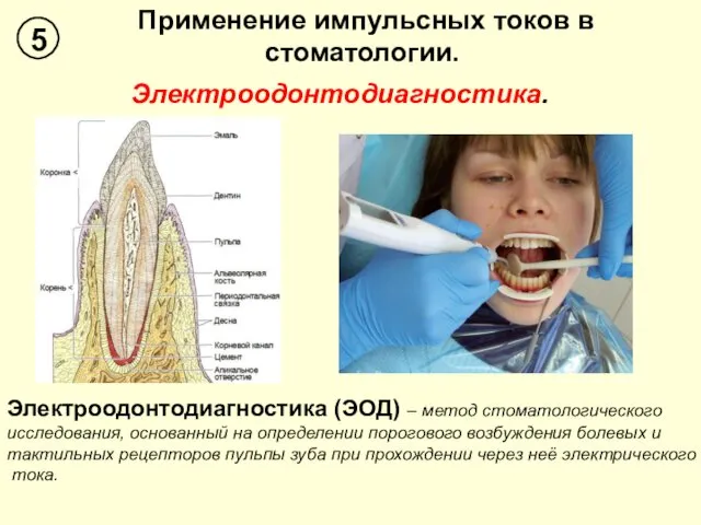 Применение импульсных токов в стоматологии. 5 Электроодонтодиагностика. Электроодонтодиагностика (ЭОД) –