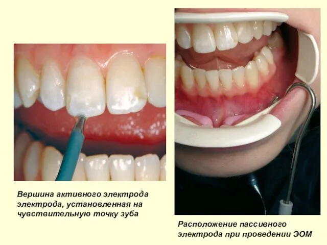 Расположение пассивного электрода при проведении ЭОМ Вершина активного электрода электрода, установленная на чувствительную точку зуба