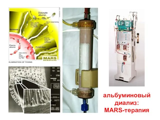 альбуминовый диализ: MARS-терапия