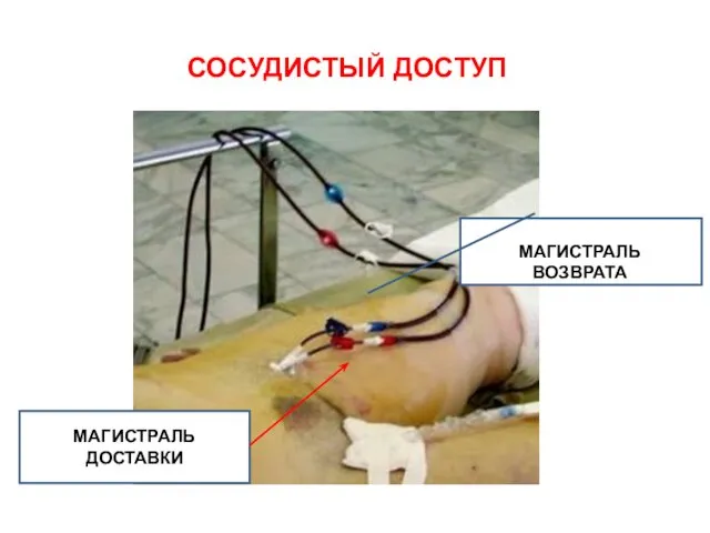 СОСУДИСТЫЙ ДОСТУП МАГИСТРАЛЬ ВОЗВРАТА МАГИСТРАЛЬ ДОСТАВКИ