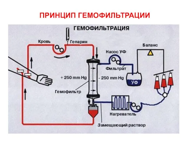 ПРИНЦИП ГЕМОФИЛЬТРАЦИИ