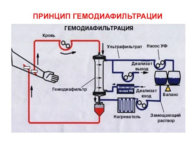 ПРИНЦИП ГЕМОДИАФИЛЬТРАЦИИ