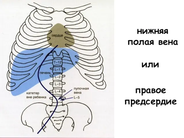 нижняя полая вена или правое предсердие