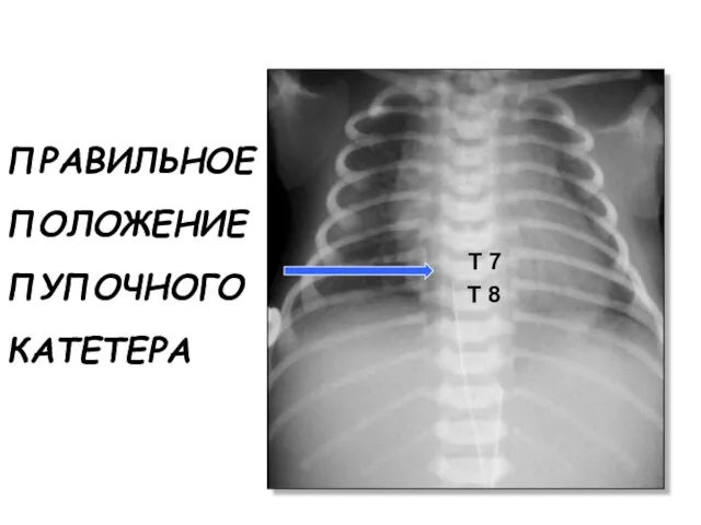 ПРАВИЛЬНОЕ ПОЛОЖЕНИЕ ПУПОЧНОГО КАТЕТЕРА Т 7 Т 8