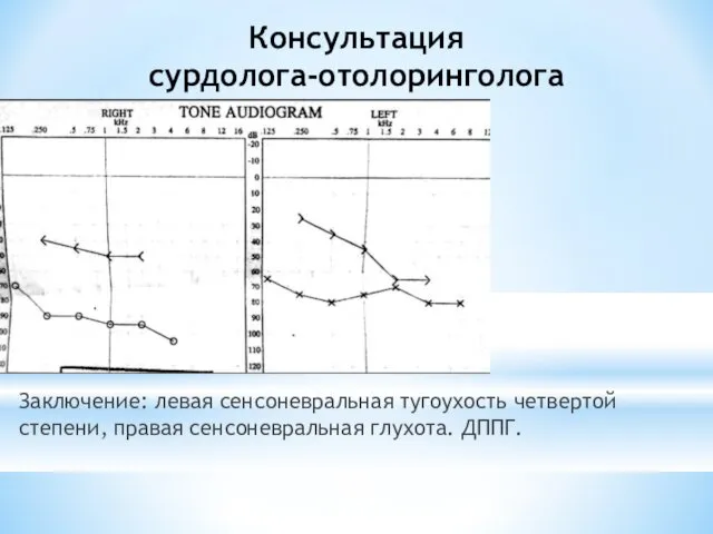 Консультация сурдолога-отолоринголога Заключение: левая сенсоневральная тугоухость четвертой степени, правая сенсоневральная глухота. ДППГ.