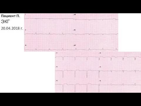 Пациент П. ЭКГ 20.04.2018 г.