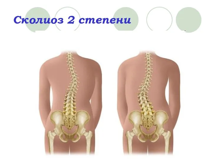 Сколиоз 2 степени