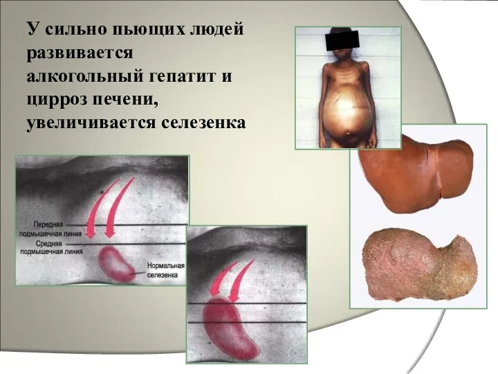 У сильно пьющих людей развивается алкогольный гепатит и цирроз печени, увеличивается селезенка