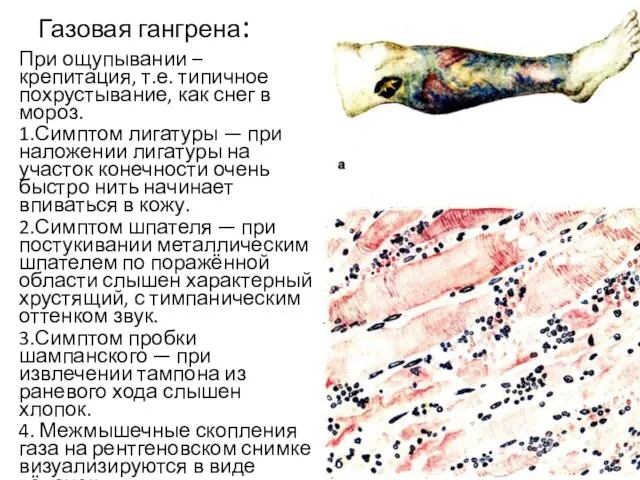 Газовая гангрена: При ощупывании – крепитация, т.е. типичное похрустывание, как