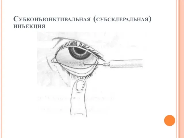 Субконъюнктивальная (субсклеральная) инъекция