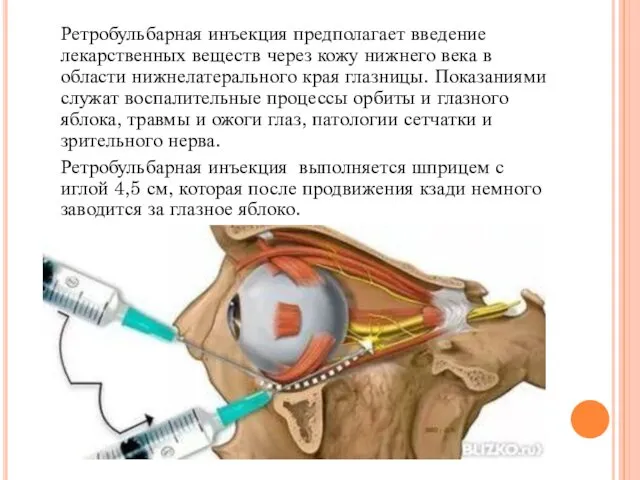 Ретробульбарная инъекция предполагает введение лекарственных веществ через кожу нижнего века в области нижнелатерального