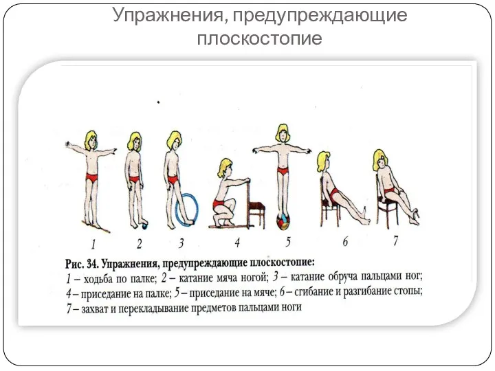 Упражнения, предупреждающие плоскостопие