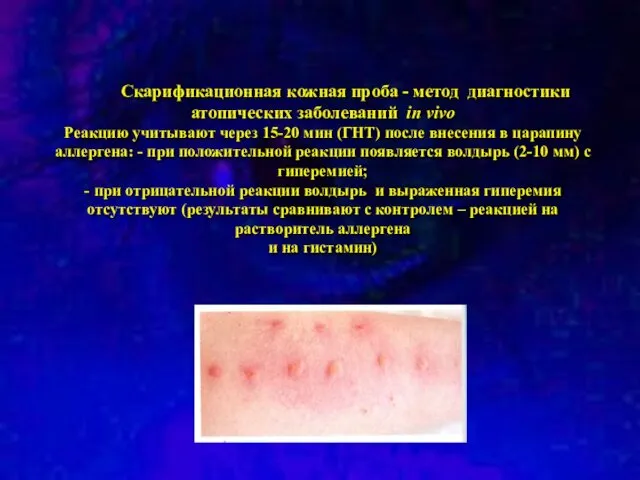 Скарификационная кожная проба - метод диагностики атопических заболеваний in vivo