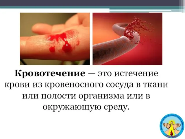 Кровотечение — это истечение крови из кровеносного сосуда в ткани