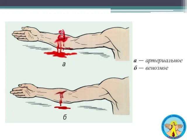 а — артериальное б — венозное