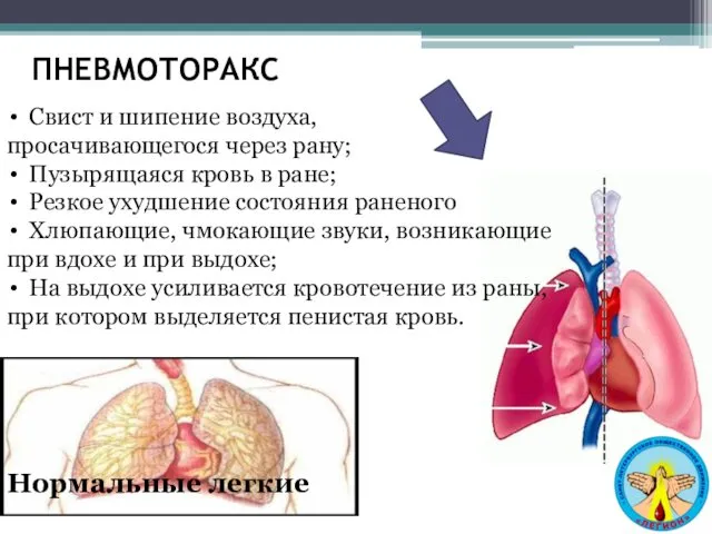 ПНЕВМОТОРАКС Нормальные легкие Свист и шипение воздуха, просачивающегося через рану;