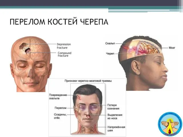 ПЕРЕЛОМ КОСТЕЙ ЧЕРЕПА