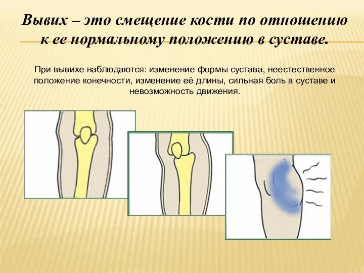 Вывих – это смещение кости по отношению к ее нормальному