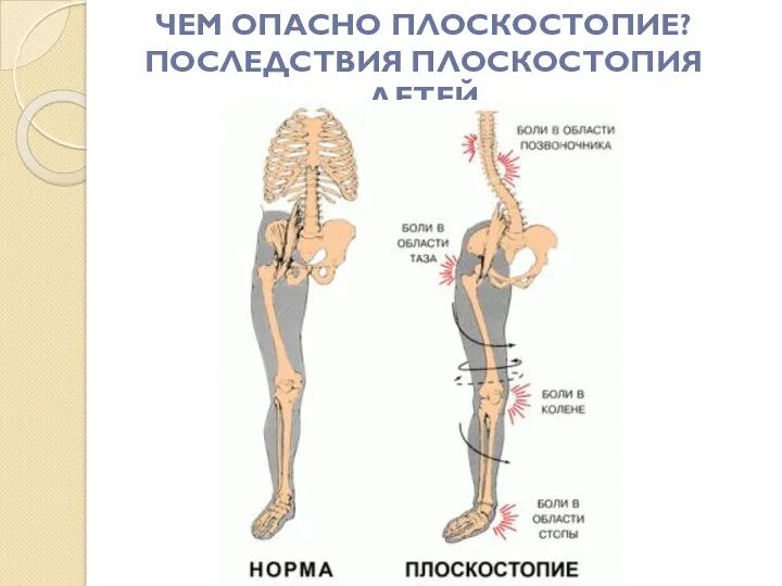 ЧЕМ ОПАСНО ПЛОСКОСТОПИЕ? ПОСЛЕДСТВИЯ ПЛОСКОСТОПИЯ ДЕТЕЙ