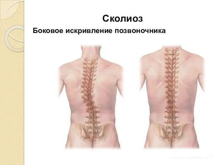 Сколиоз Боковое искривление позвоночника