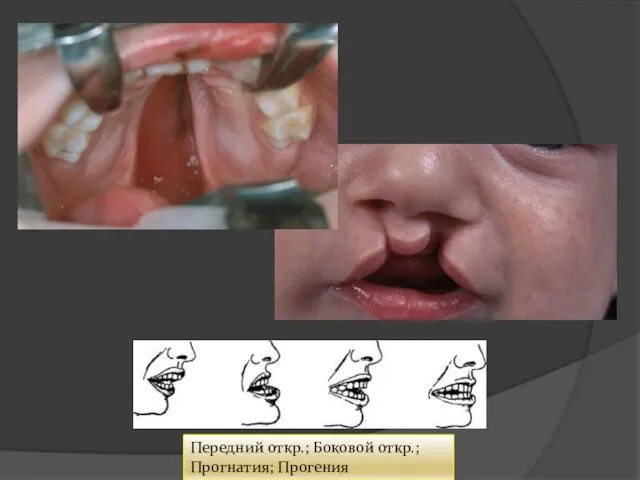 Передний откр.; Боковой откр.; Прогнатия; Прогения