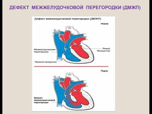 ДЕФЕКТ МЕЖЖЕЛУДОЧКОВОЙ ПЕРЕГОРОДКИ (ДМЖП)