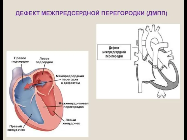 ДЕФЕКТ МЕЖПРЕДСЕРДНОЙ ПЕРЕГОРОДКИ (ДМПП)