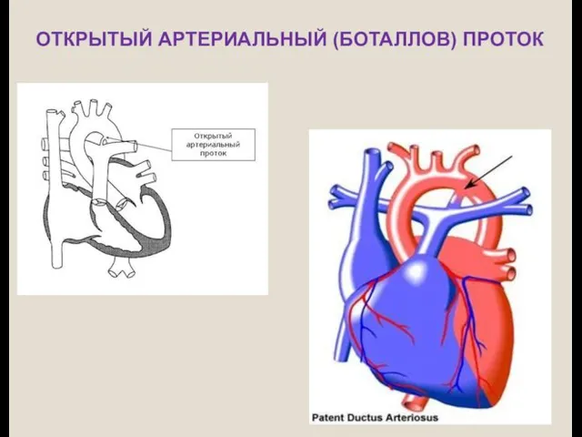 ОТКРЫТЫЙ АРТЕРИАЛЬНЫЙ (БОТАЛЛОВ) ПРОТОК