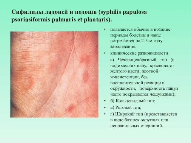 Сифилиды ладоней и подошв (syphilis papulosa psoriasiformis palmaris et plantaris). появляется обычно в